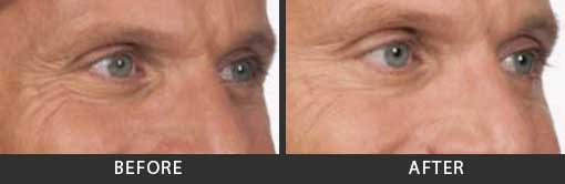 Before and After Photo