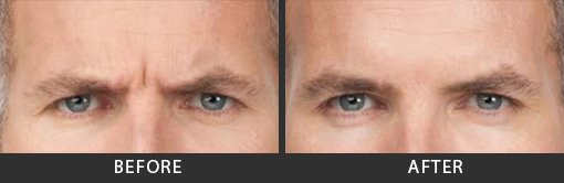 Botox Frown Lines Before and After