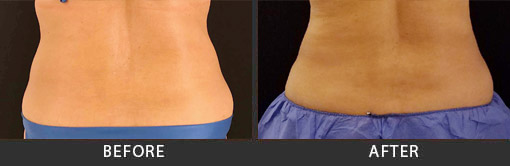 CoolSculpting Studio City