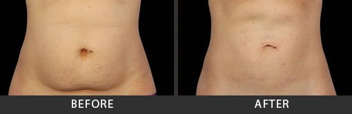 Before and After Photo