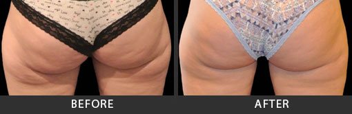 Before and After Photo