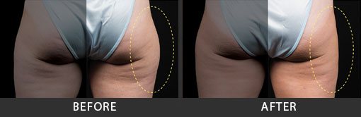 Before and After Photo