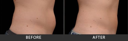 Before and After Photo