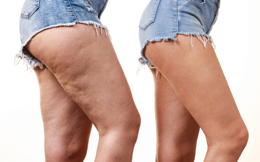 coolsculpting cellulite 