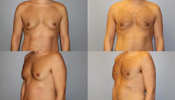 coolsculpting for men