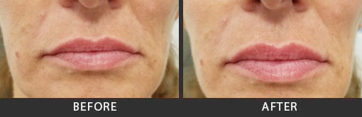 Before and After Photo