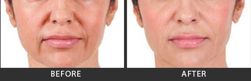 Before and After Photo