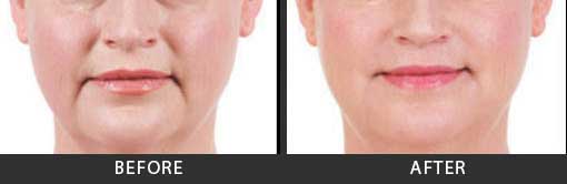 Before and After Photo