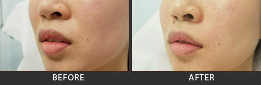 Before and After Photo