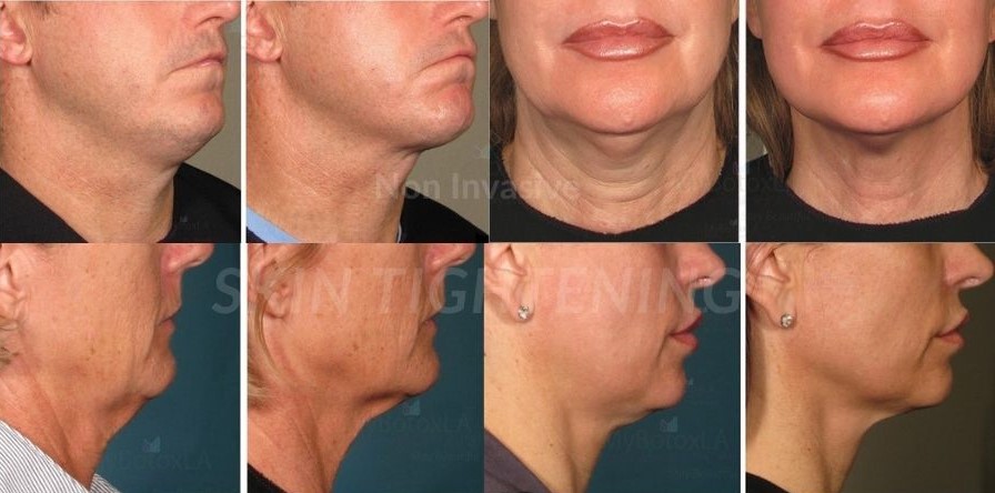 Non Invasive Skin Tightening Los Angeles