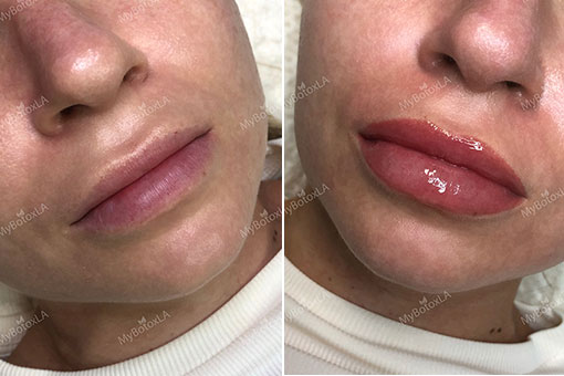 Before and After Photo