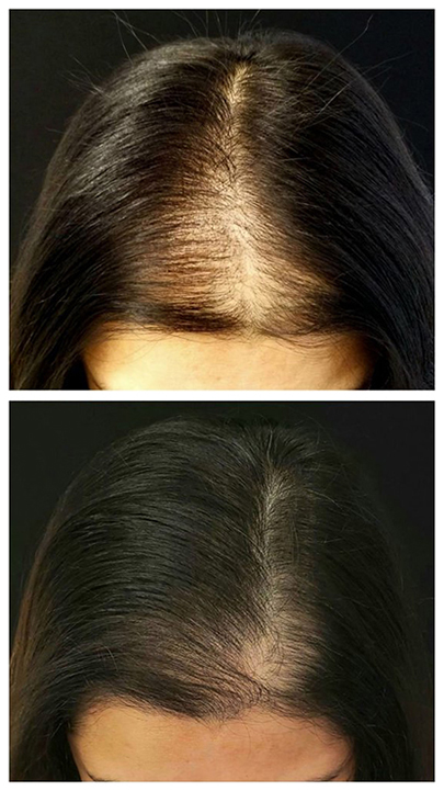 PRP Sherman Oaks, Encino & Studio City