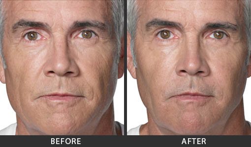 Before and After Photo