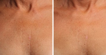 Before and After Photo