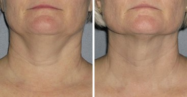 Before and After Photo