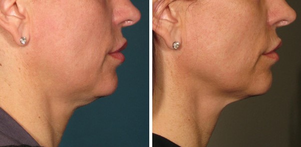 ultherapy before and after 360days jowels