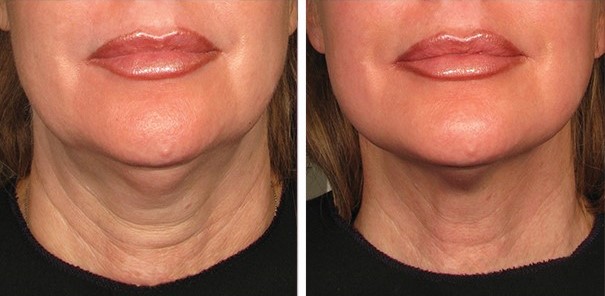 ultherapy before and after 90days neck
