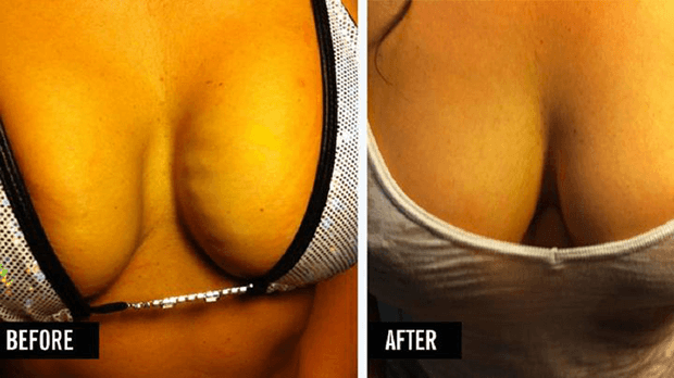 Vampire Breast Lift Photo